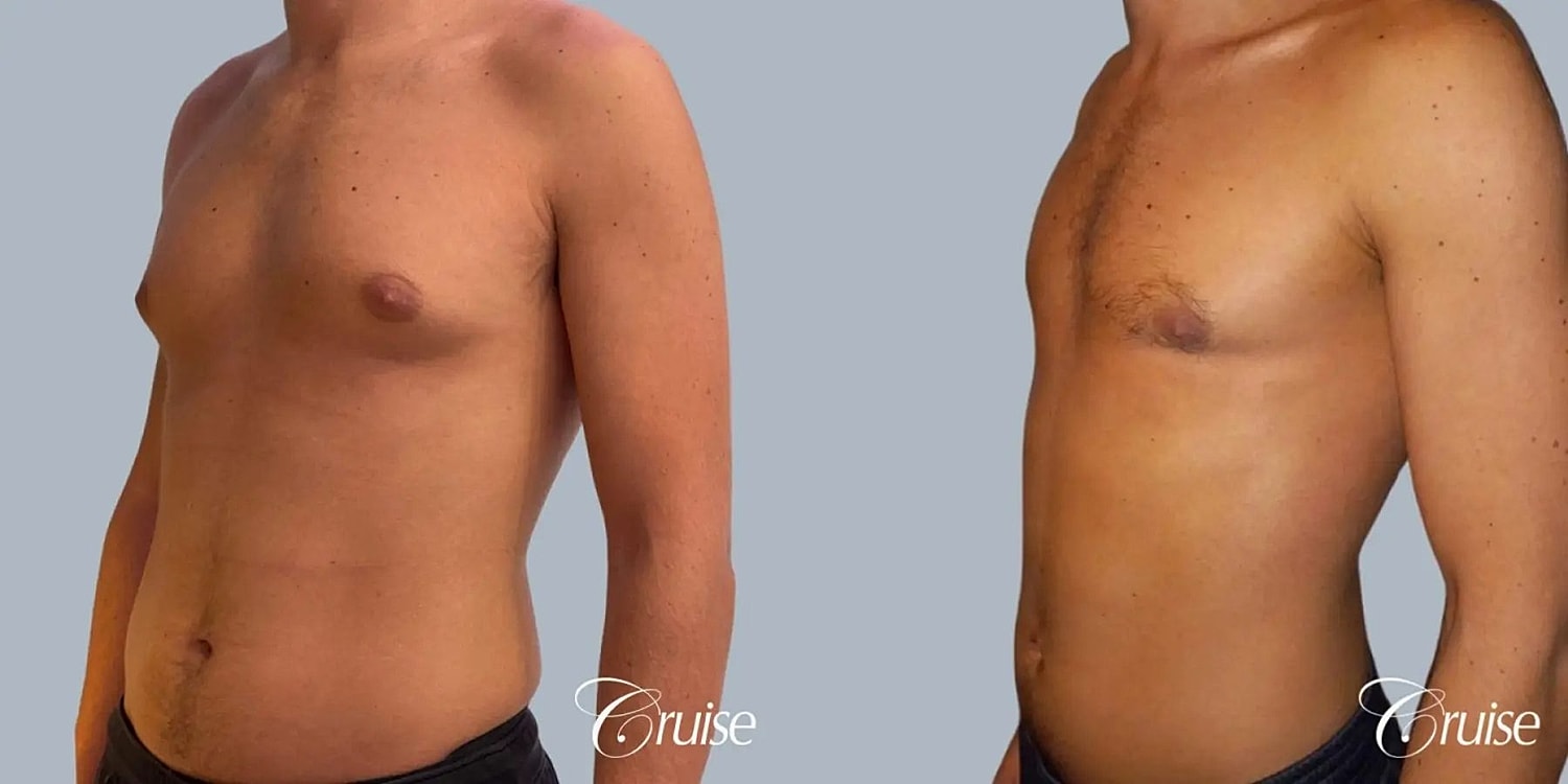Gynecomastia Surgery Before & After