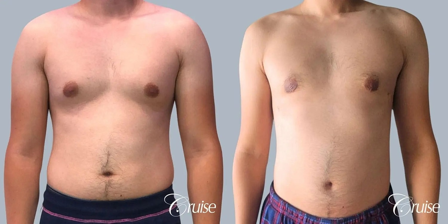 Gynecomastia Surgery Before & After