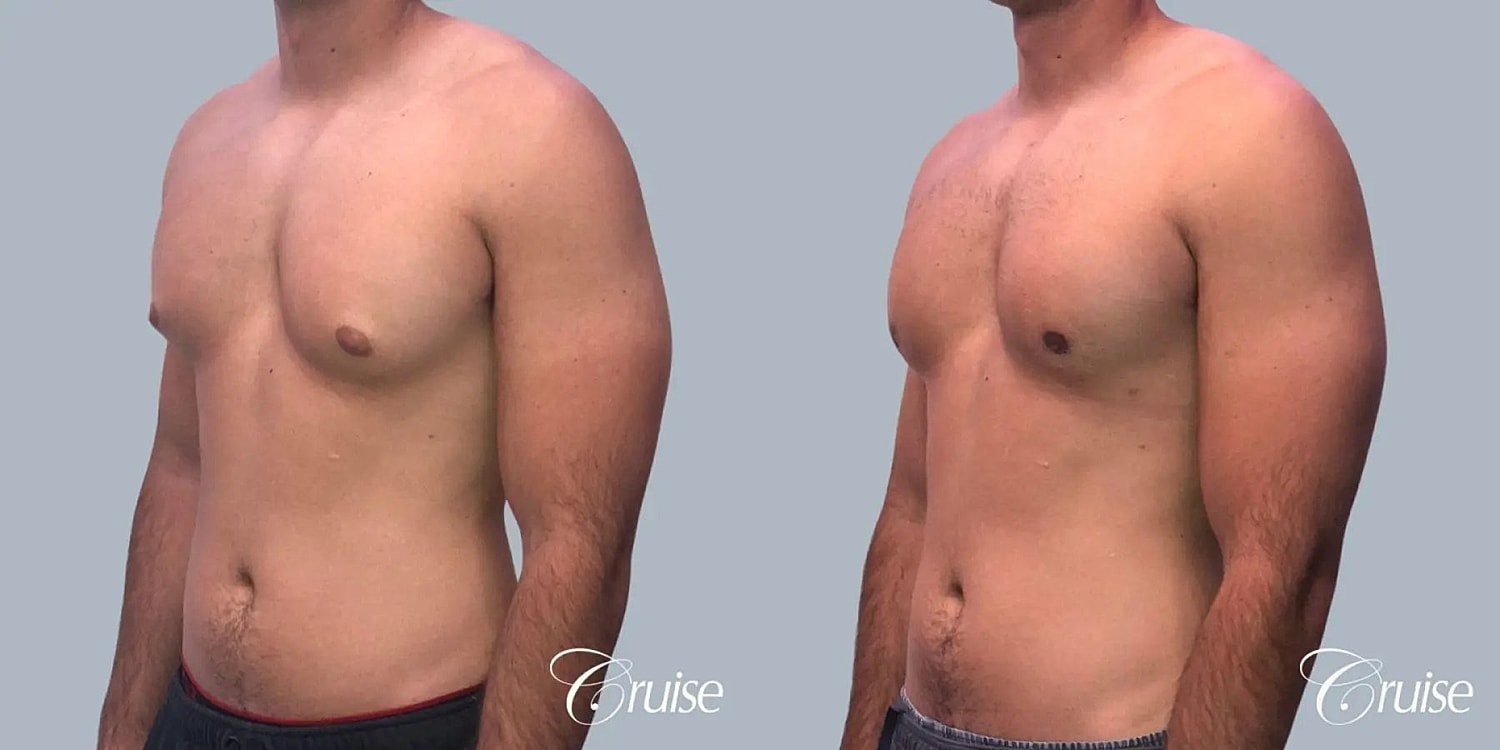 Gynecomastia Surgery Before & After