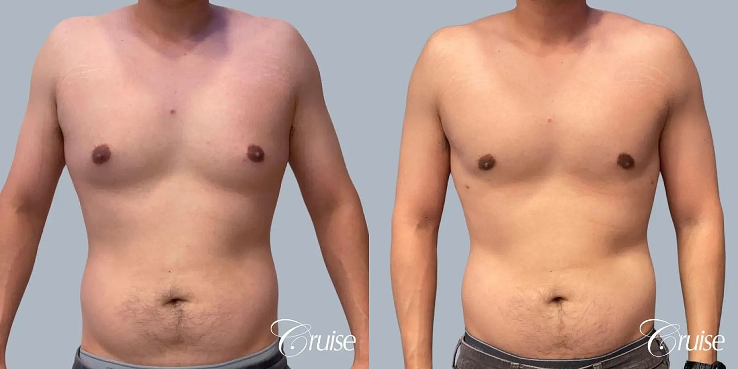 Gynecomastia Surgery Before & After