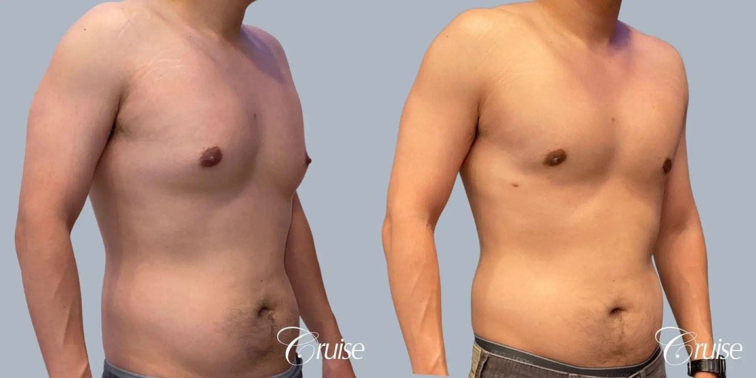 Gynecomastia Surgery Before & After