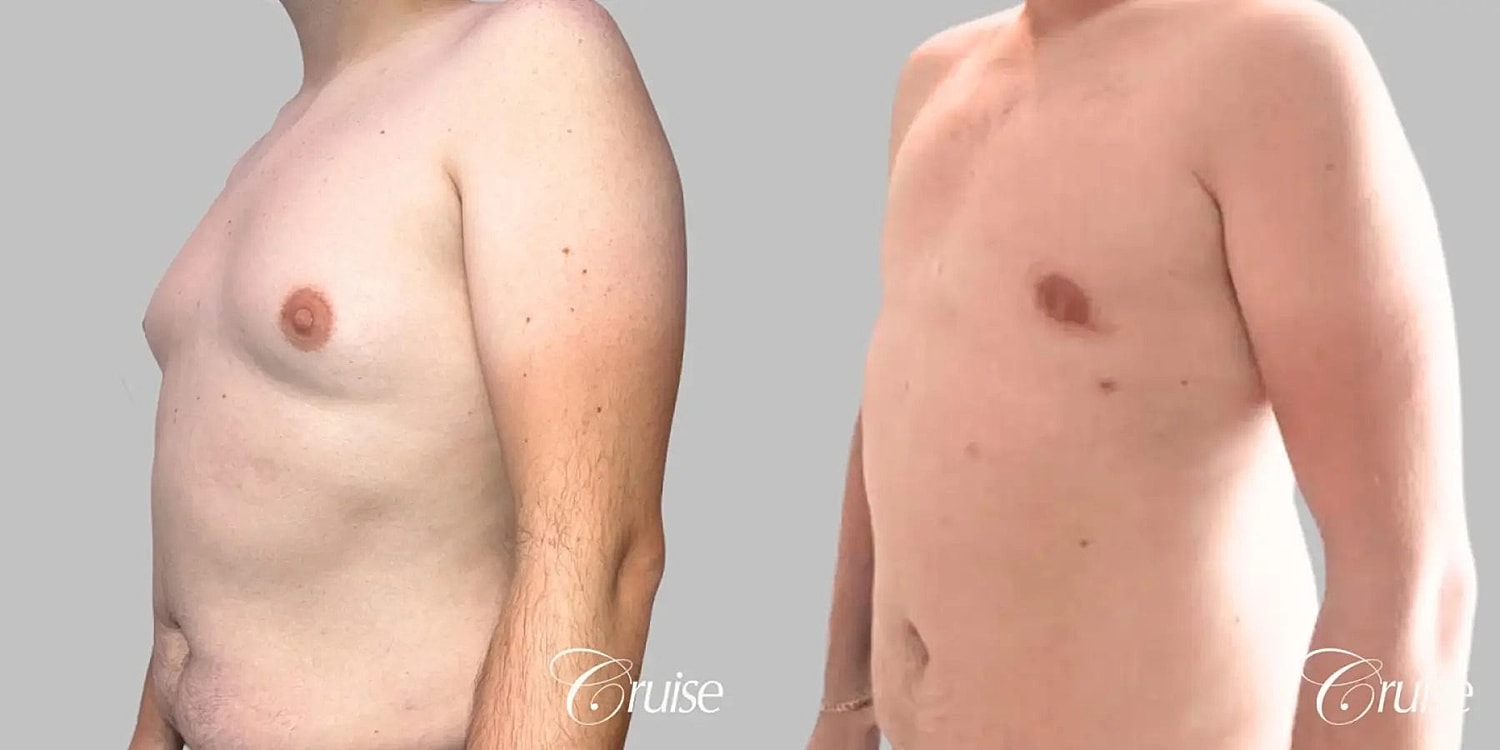 Gynecomastia Surgery Before & After