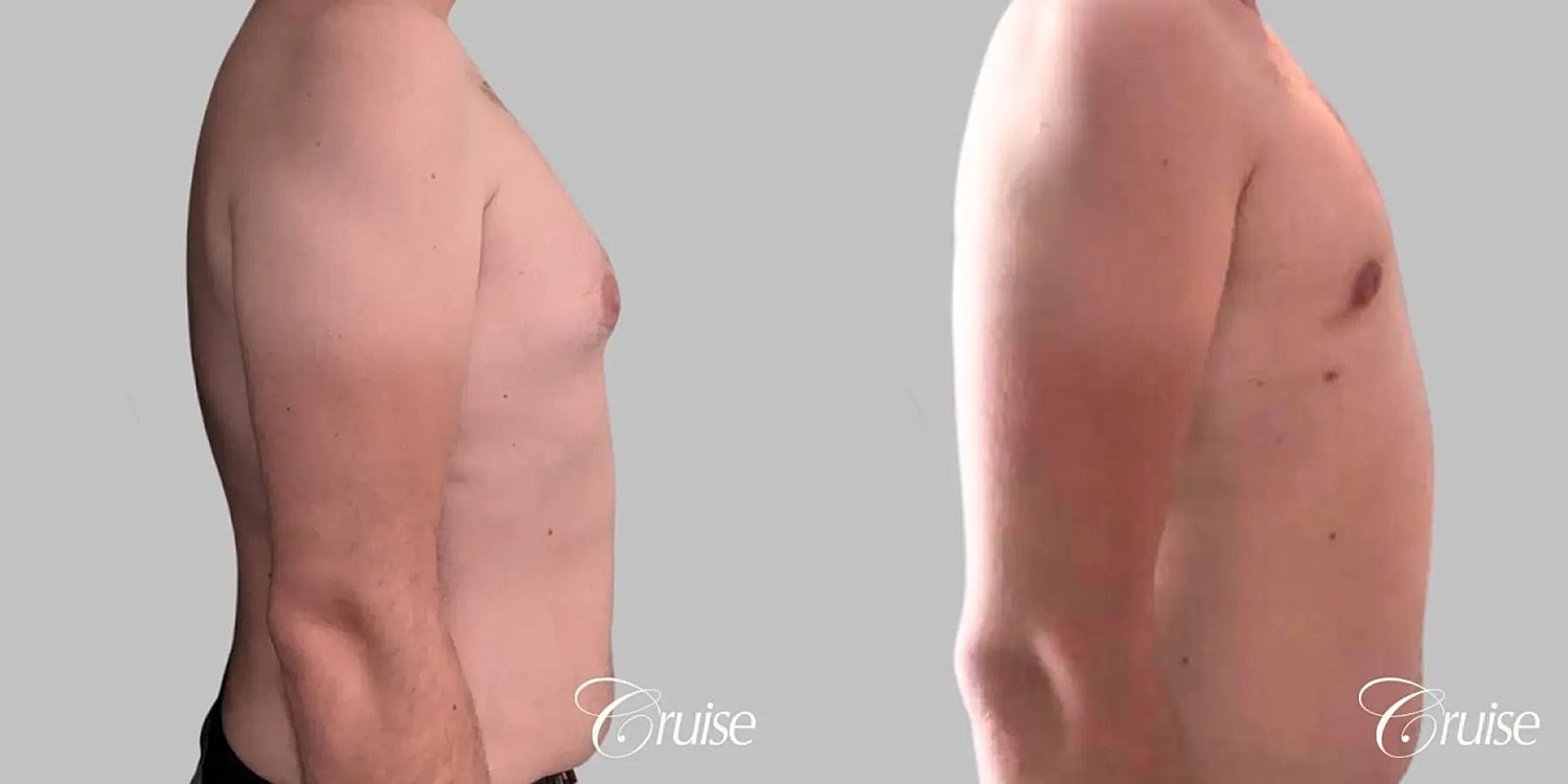 Gynecomastia Surgery Before & After