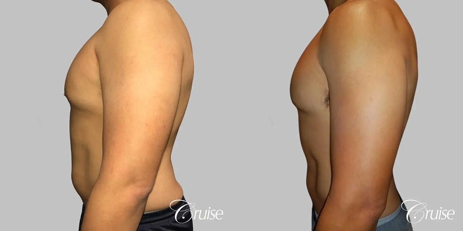 Gynecomastia Surgery Before & After