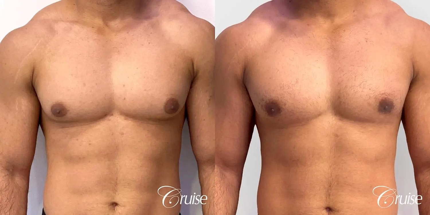 Gynecomastia Surgery Before & After
