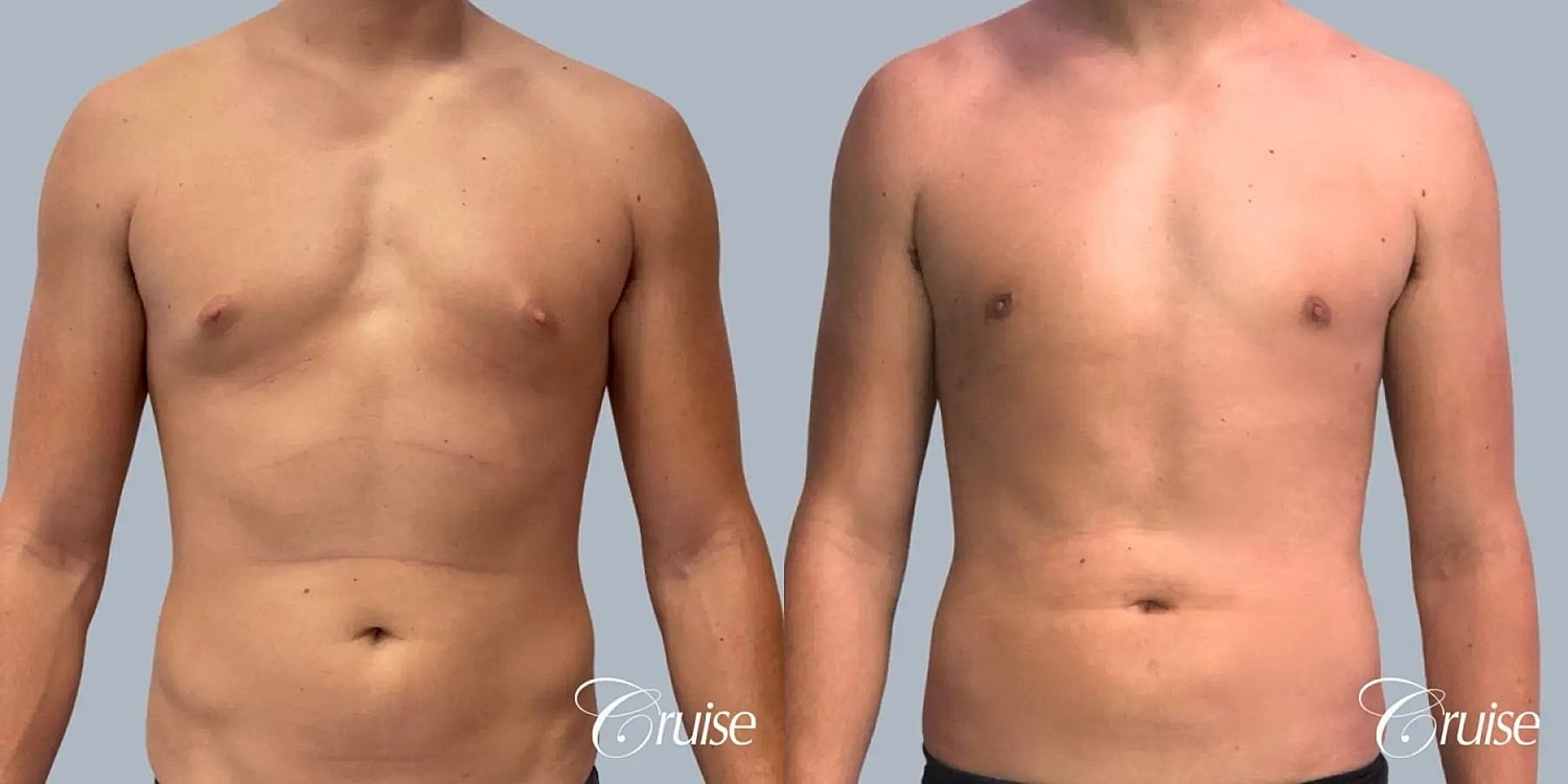 Gynecomastia Surgery Before & After