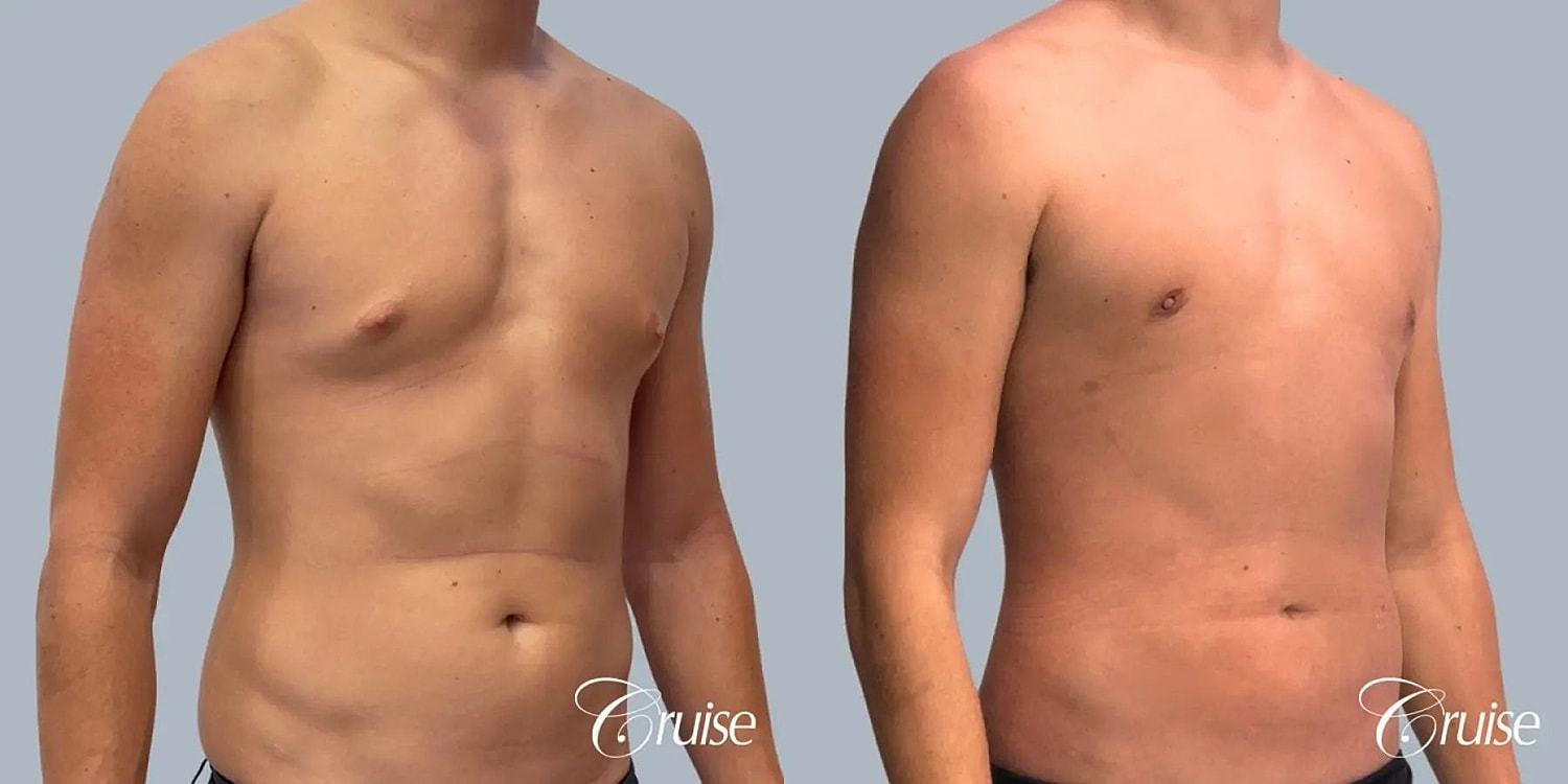 Gynecomastia Surgery Before & After