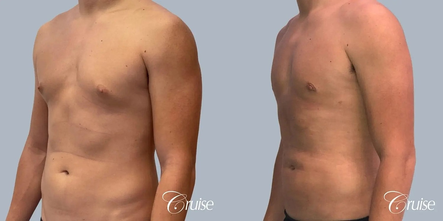 Gynecomastia Surgery Before & After