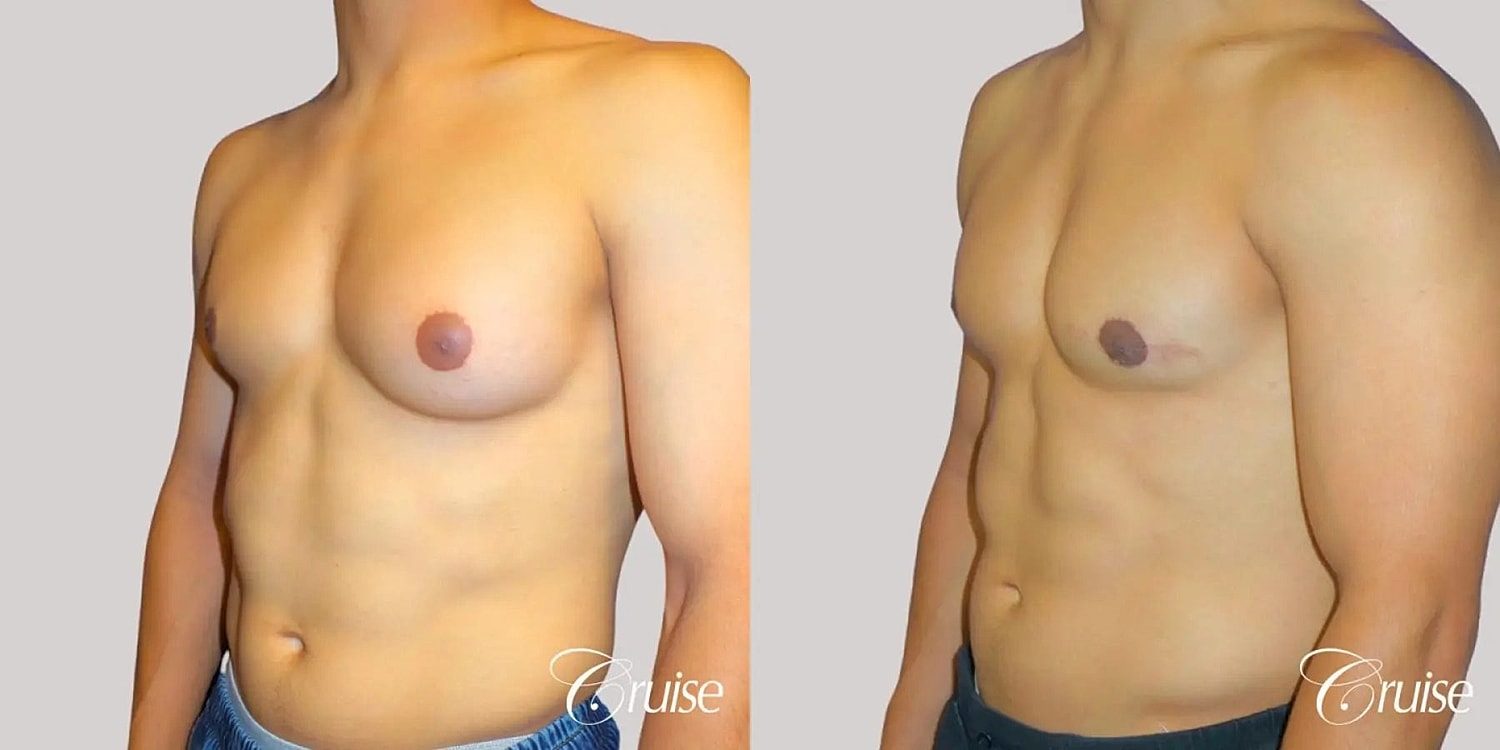 Gynecomastia Surgery Before & After