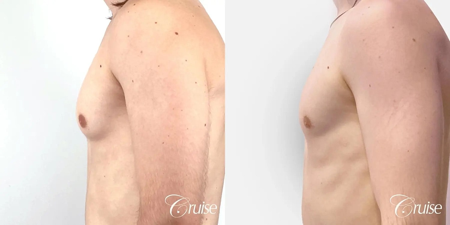 Gynecomastia Surgery Before & After
