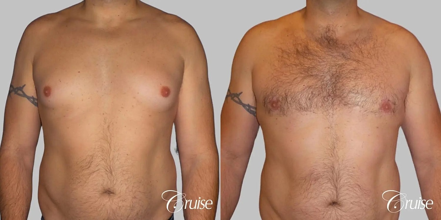 Gynecomastia Surgery Before & After