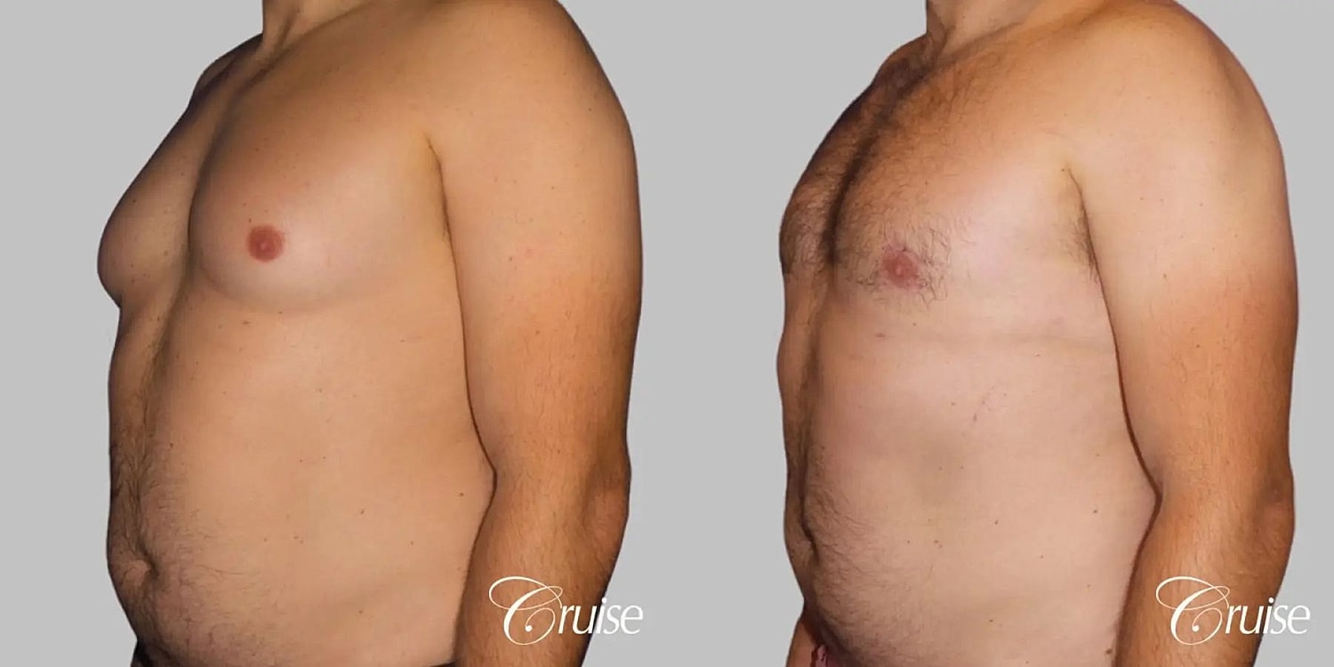 Gynecomastia Surgery Before & After