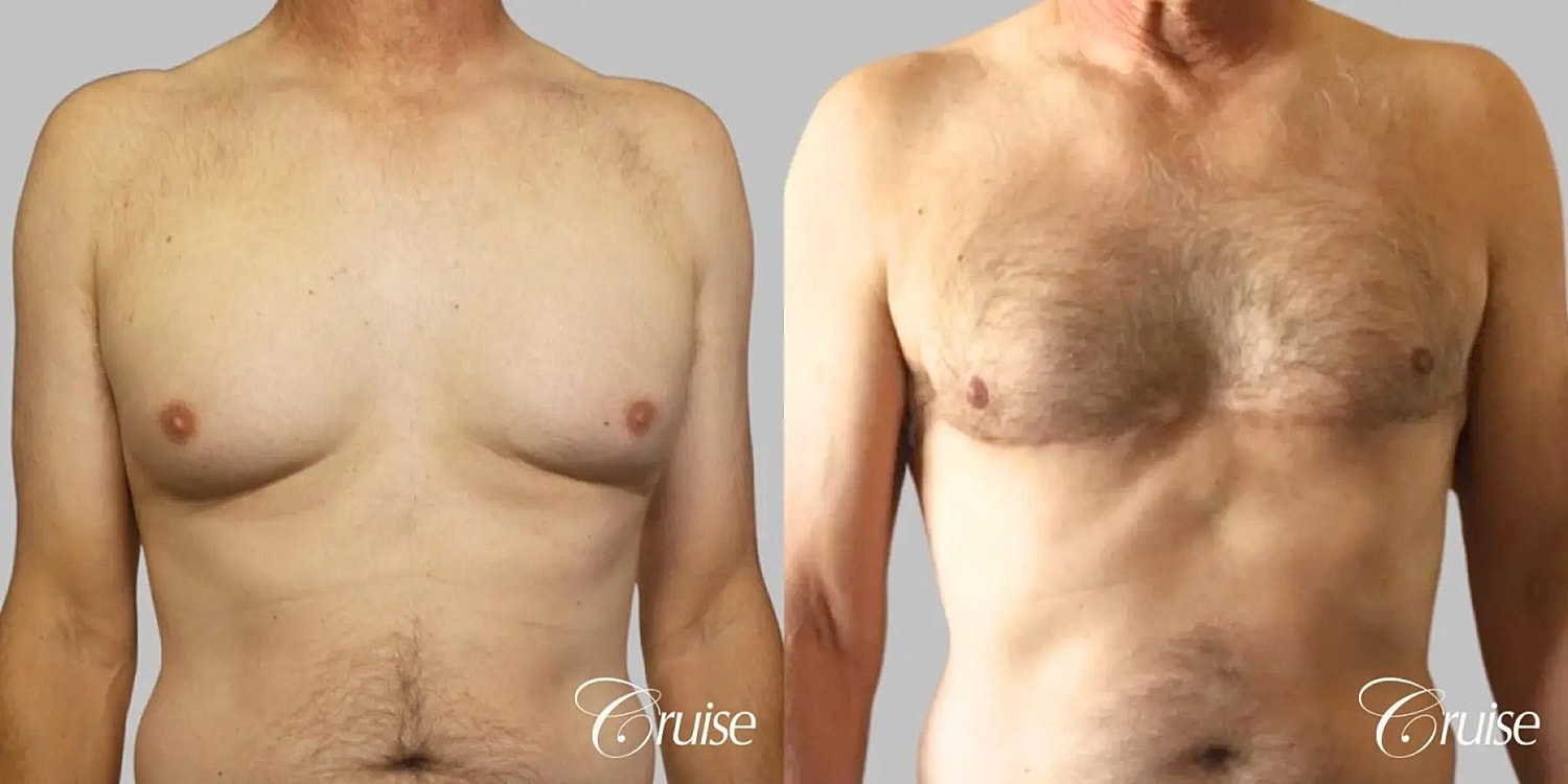Gynecomastia Surgery Before & After