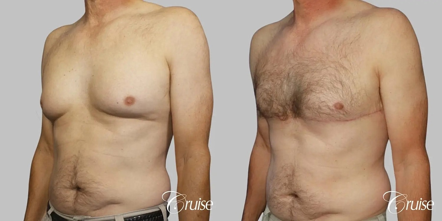 Gynecomastia Surgery Before & After