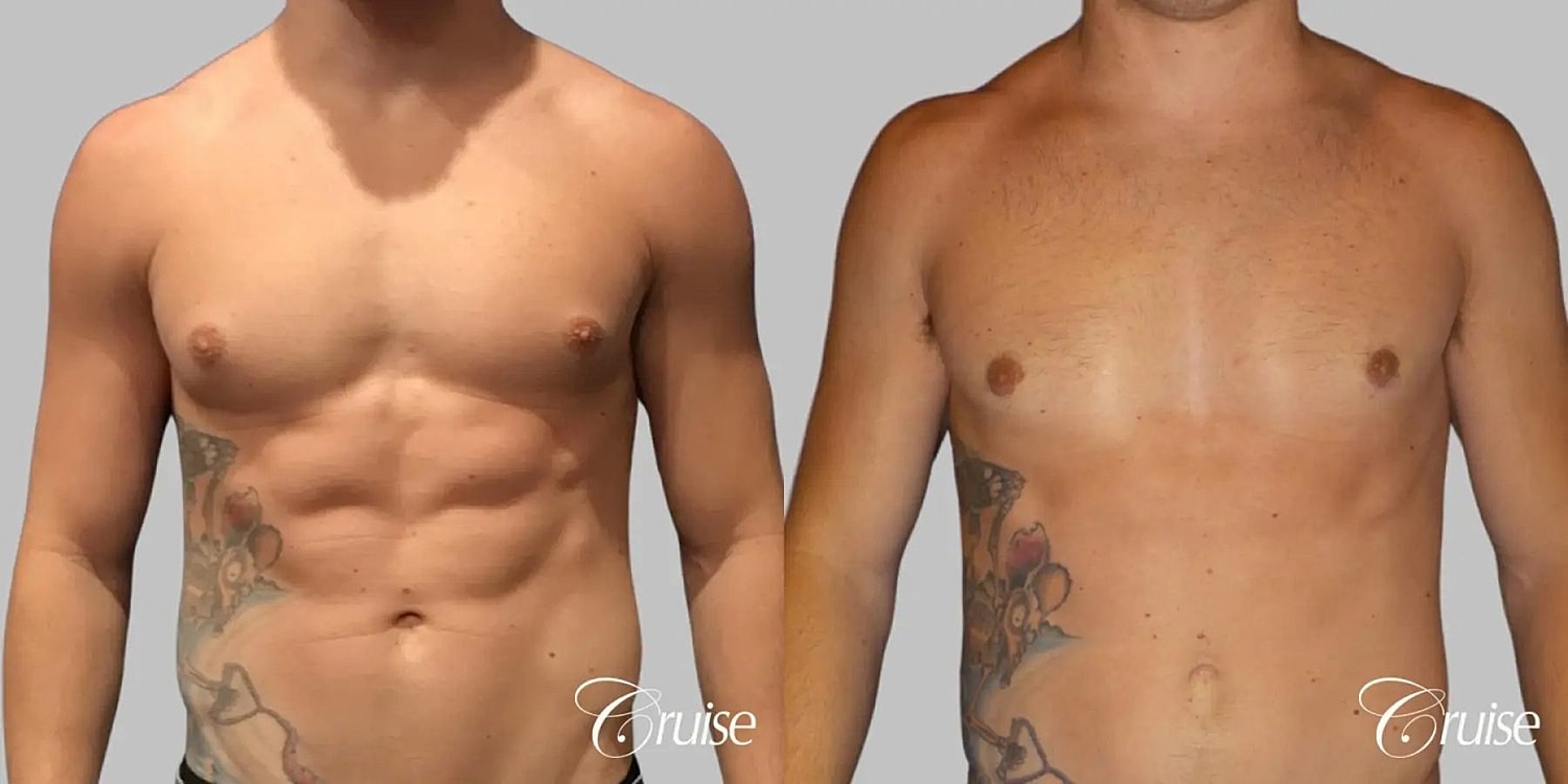 Gynecomastia Surgery Before & After