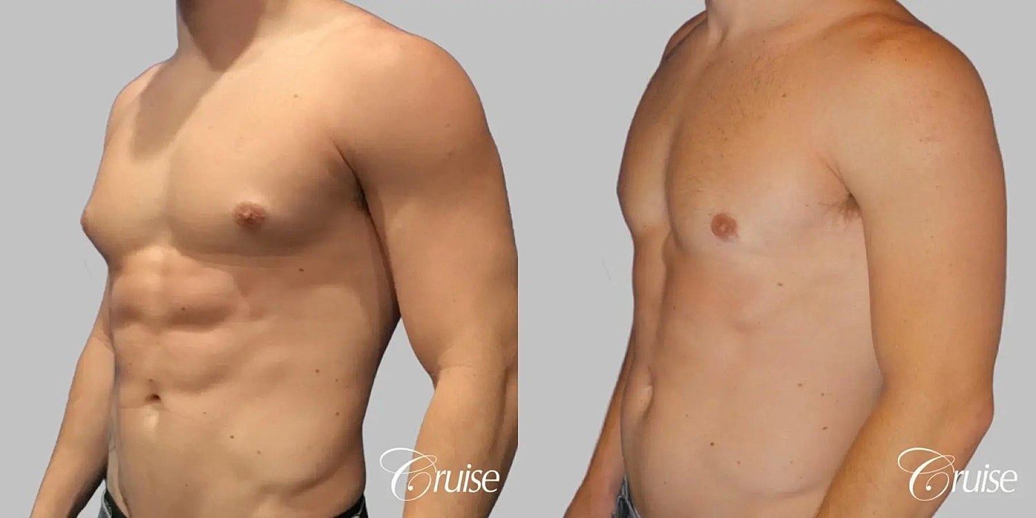 Gynecomastia Surgery Before & After