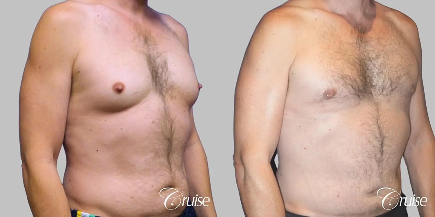 Gynecomastia Surgery Before & After