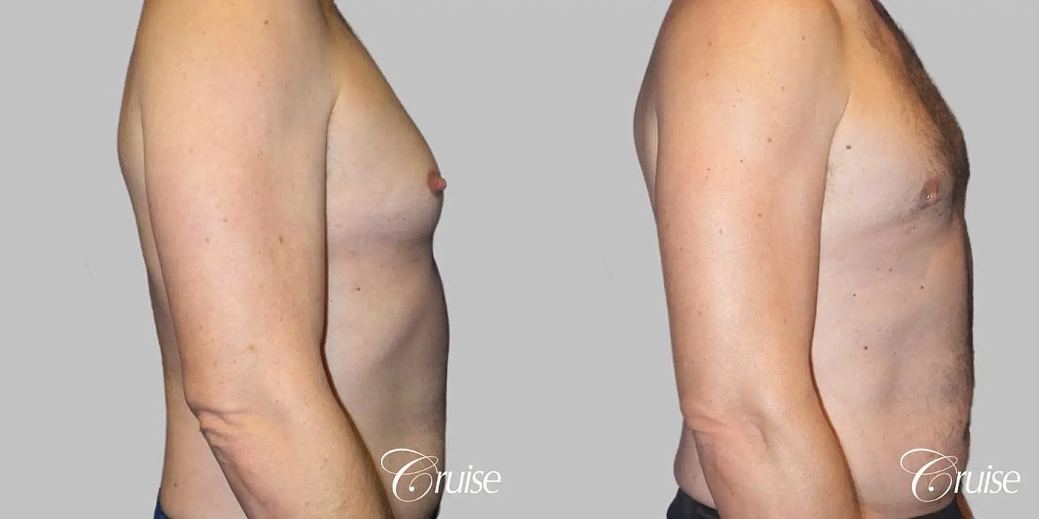 Gynecomastia Surgery Before & After