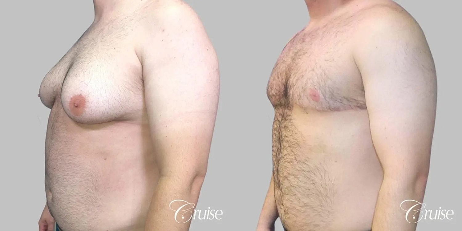 Gynecomastia Surgery Before & After