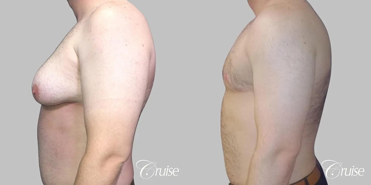 Gynecomastia Surgery Before & After