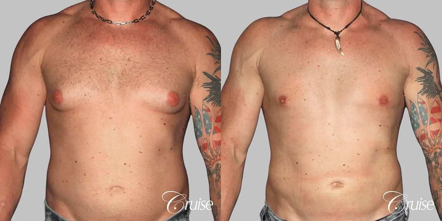 Gynecomastia Surgery Before & After