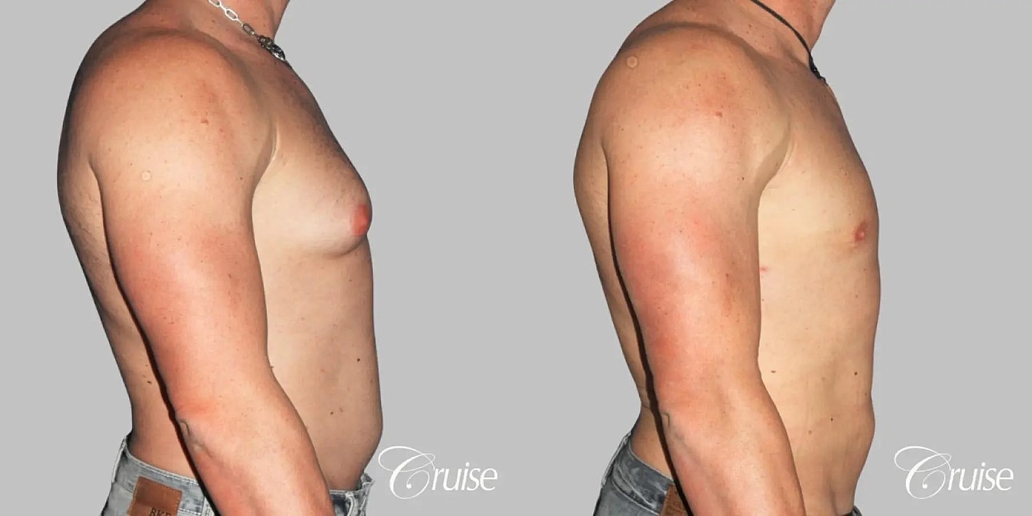 Gynecomastia Surgery Before & After