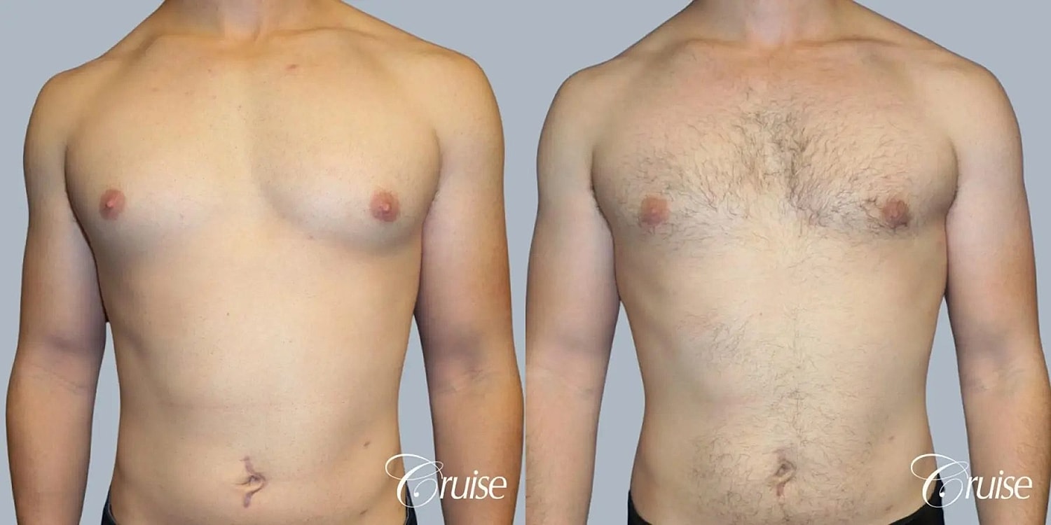 Gynecomastia Surgery Before & After