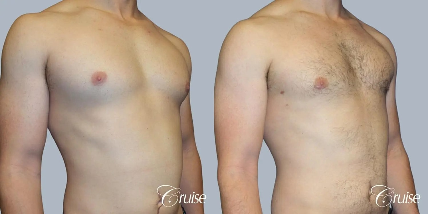 Gynecomastia Surgery Before & After