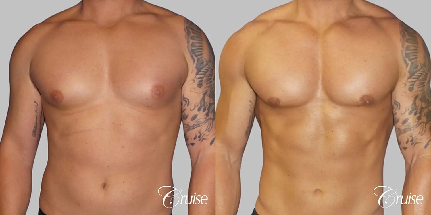 Gynecomastia Surgery Before & After