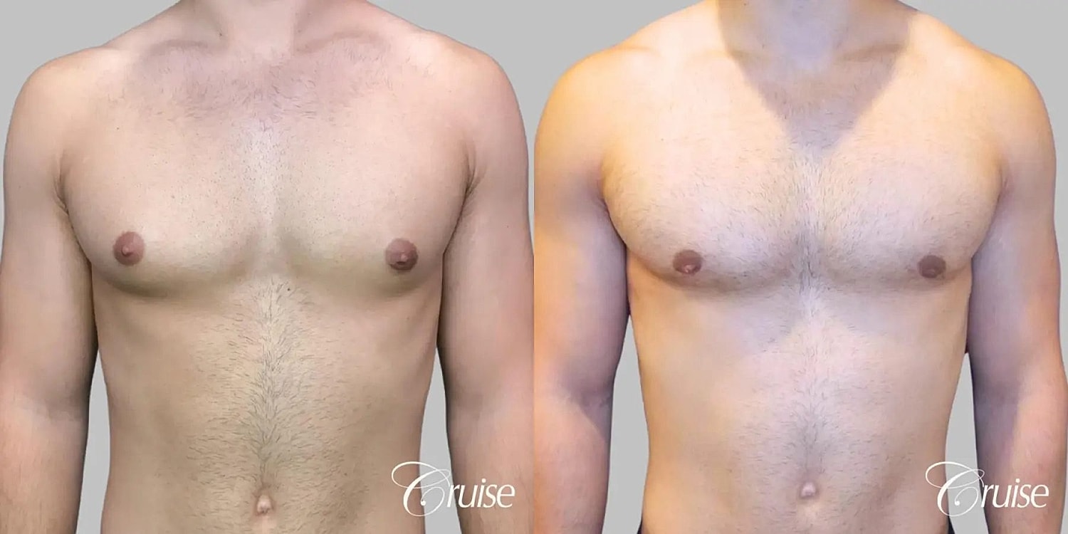 Gynecomastia Surgery Before & After