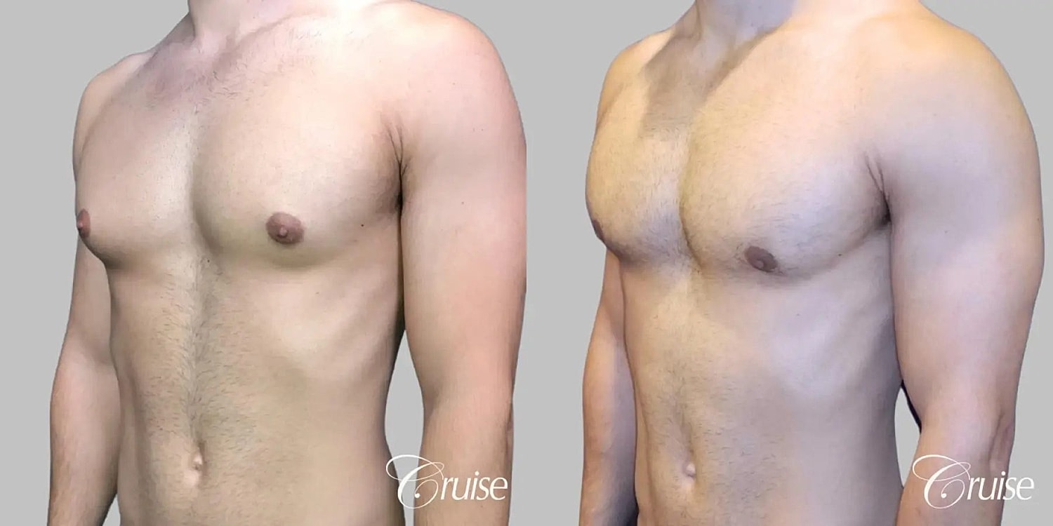Gynecomastia Surgery Before & After