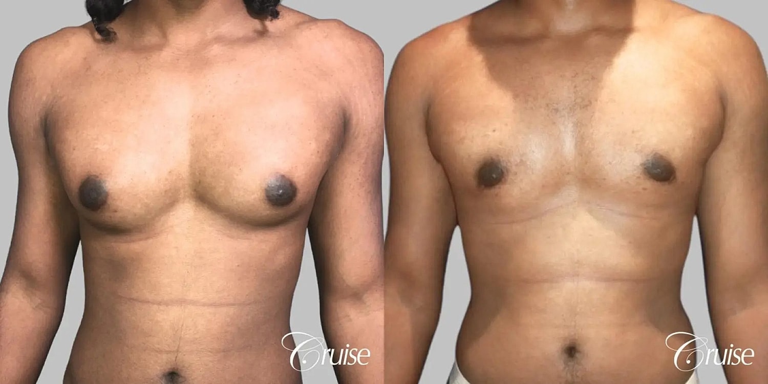 Gynecomastia Surgery Before & After