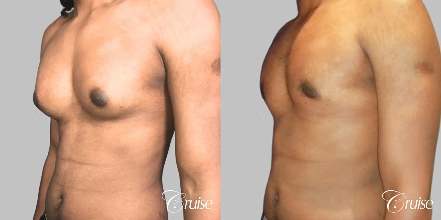 Gynecomastia Surgery Before & After