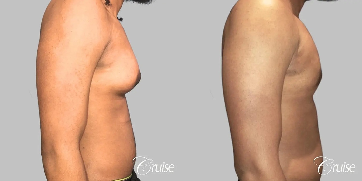 Gynecomastia Surgery Before & After