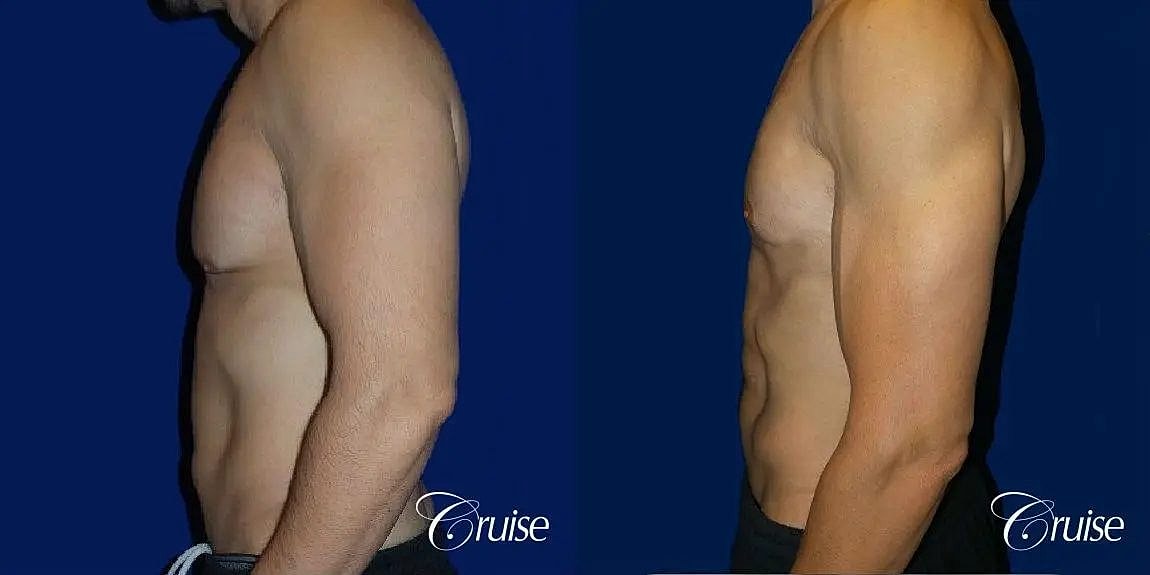 Gynecomastia Surgery Before & After