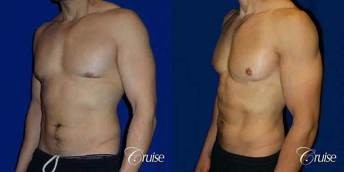 Gynecomastia Surgery Before & After