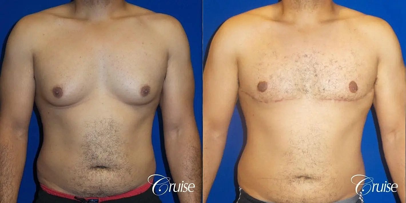Gynecomastia Surgery Before & After