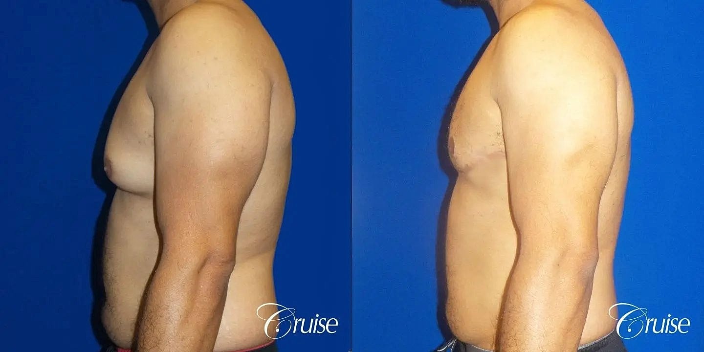 Gynecomastia Surgery Before & After