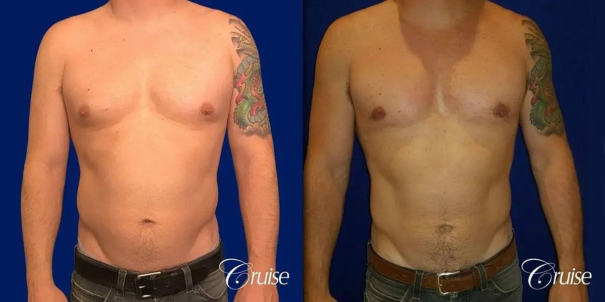 Gynecomastia Surgery Before & After