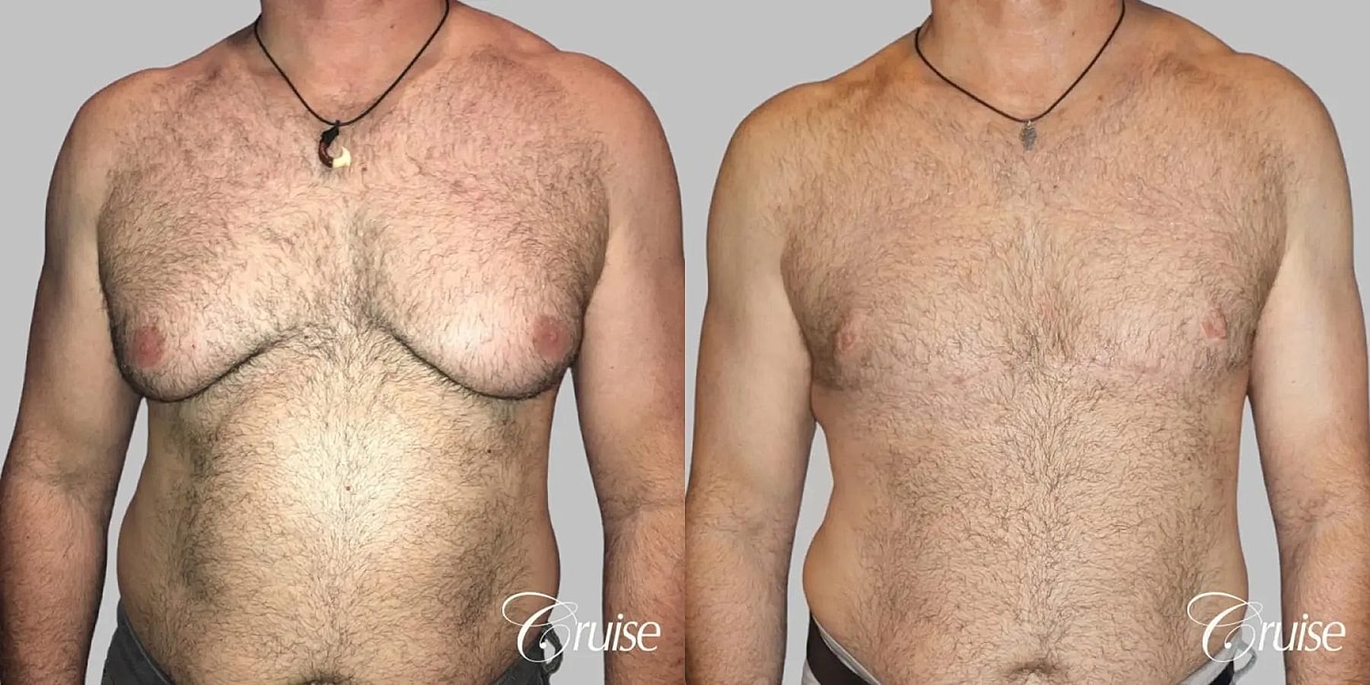 Gynecomastia Surgery Before & After