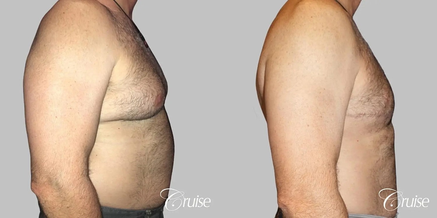 Gynecomastia Surgery Before & After