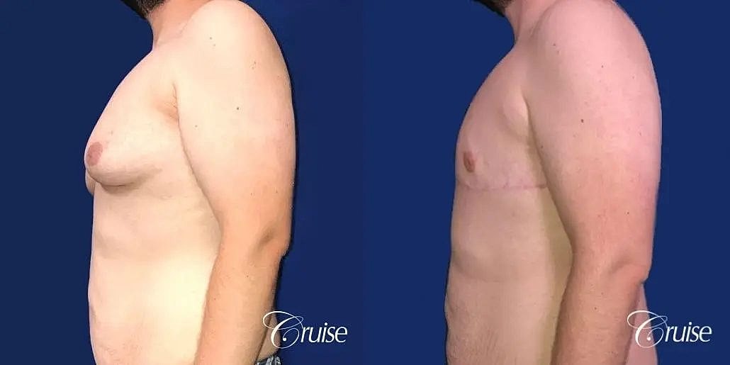 Gynecomastia Surgery Before & After