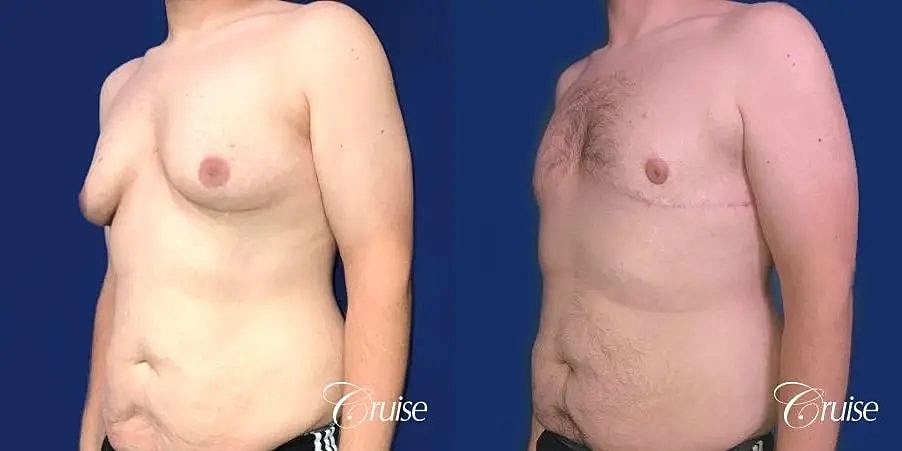 Gynecomastia Surgery Before & After