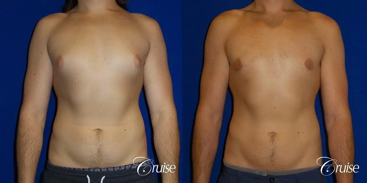 Gynecomastia Surgery Before & After