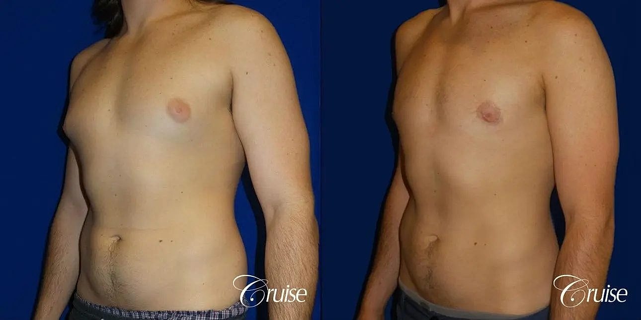 Gynecomastia Surgery Before & After
