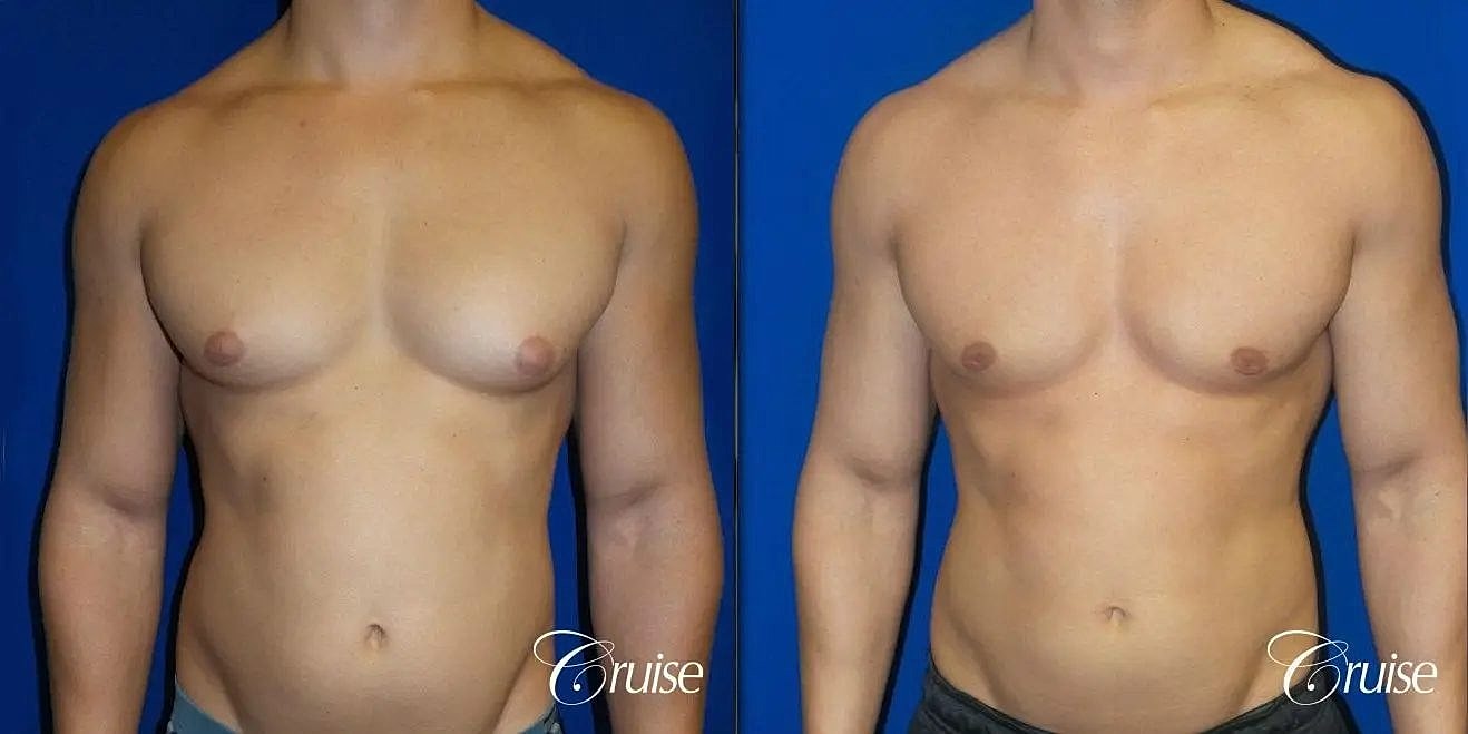 Gynecomastia Surgery Before & After