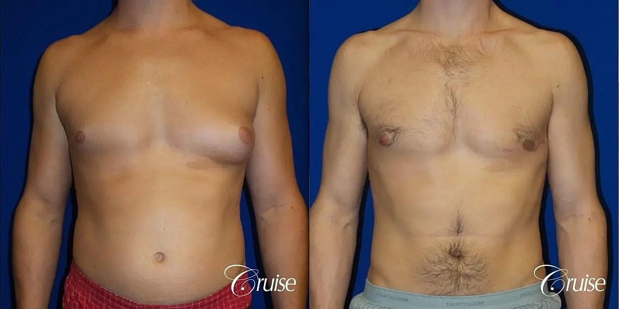Gynecomastia Surgery Before & After