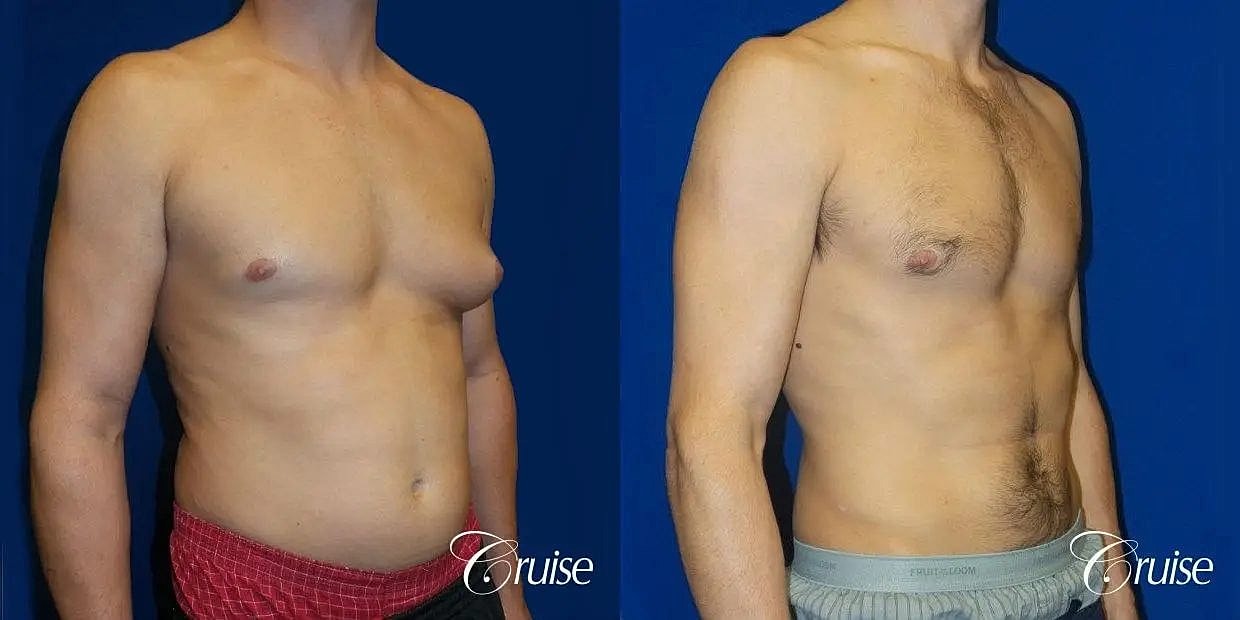 Gynecomastia Surgery Before & After