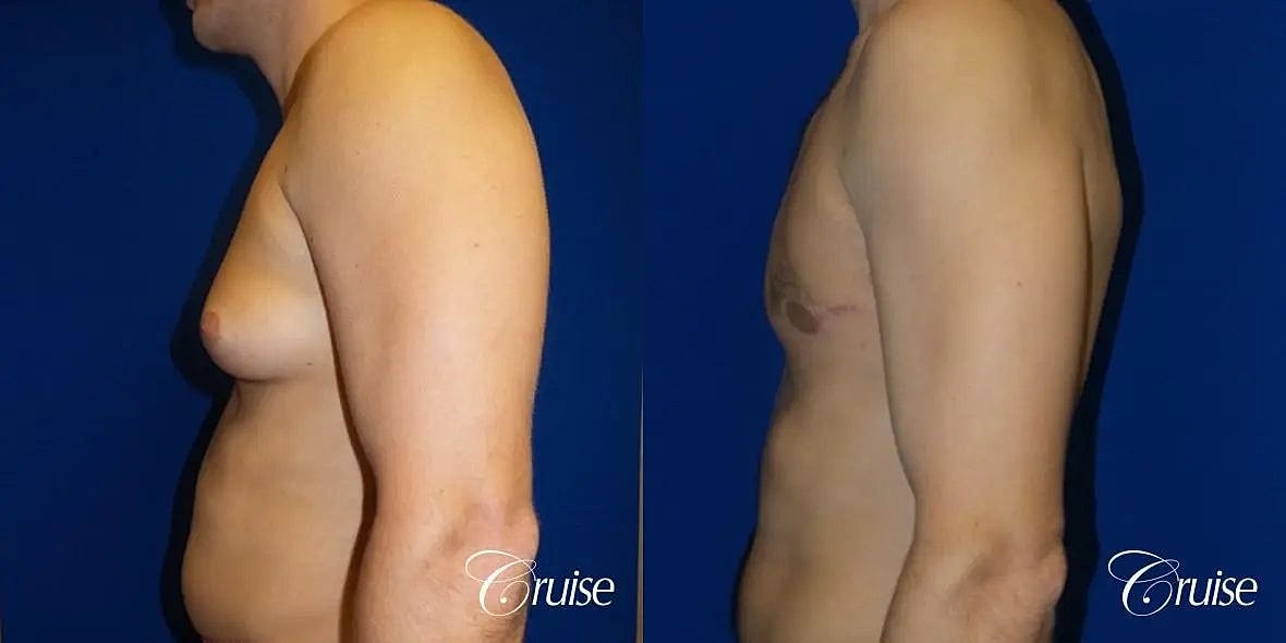 Gynecomastia Surgery Before & After