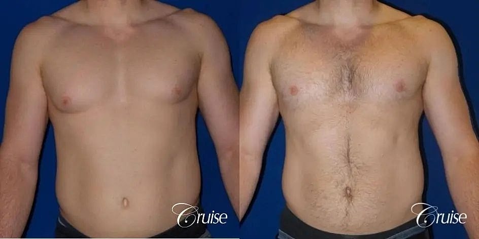 Gynecomastia Surgery Before & After